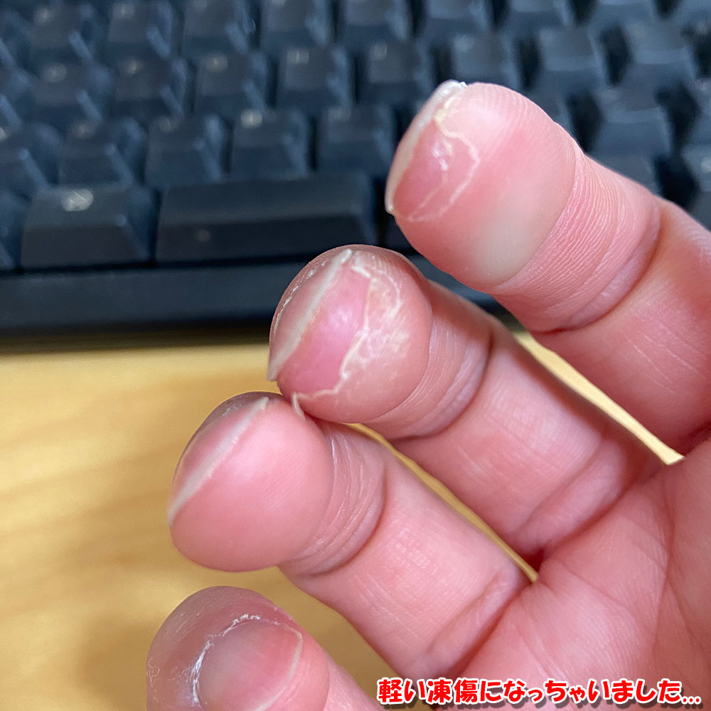 軽い凍傷になっちゃいました...